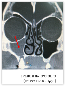 צילום רנטגן של גולגולת עם חץ מצביע על סינוסיטיס.